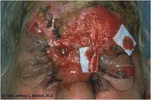 Basal Cell Carcinoma of The Face (Cancer)